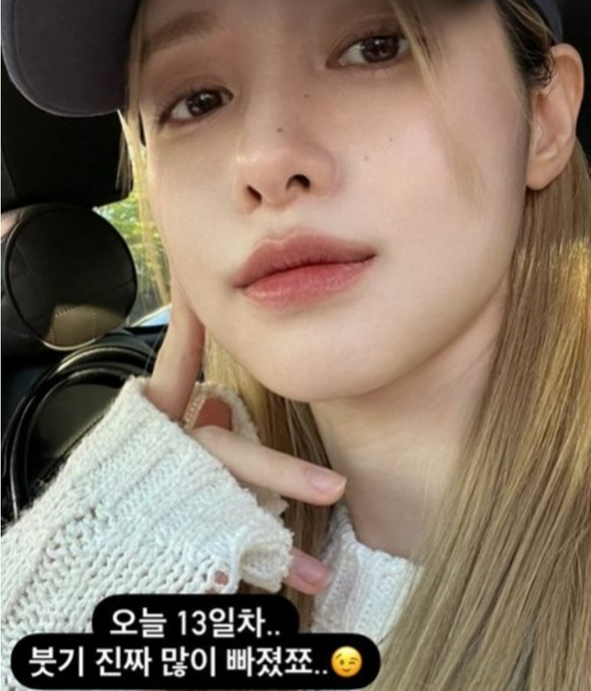 “유깻잎은 비교도 안되네”.. 성형수술 후 떡상한 인플루언서, 얼마나 다르길래?